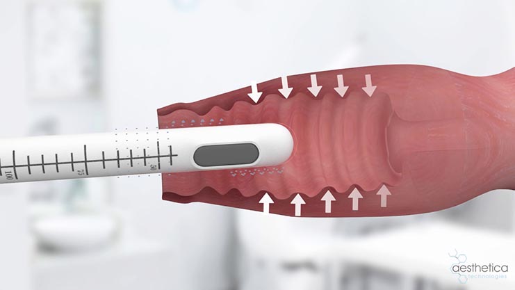 hifu-vag-3